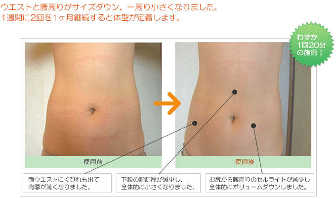 部分痩せ【お腹の実証例】画像